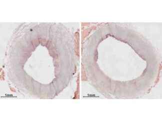 Terapia de precisión con nanopartículas para combatir enfermedades cardiacas news-16102024-021934